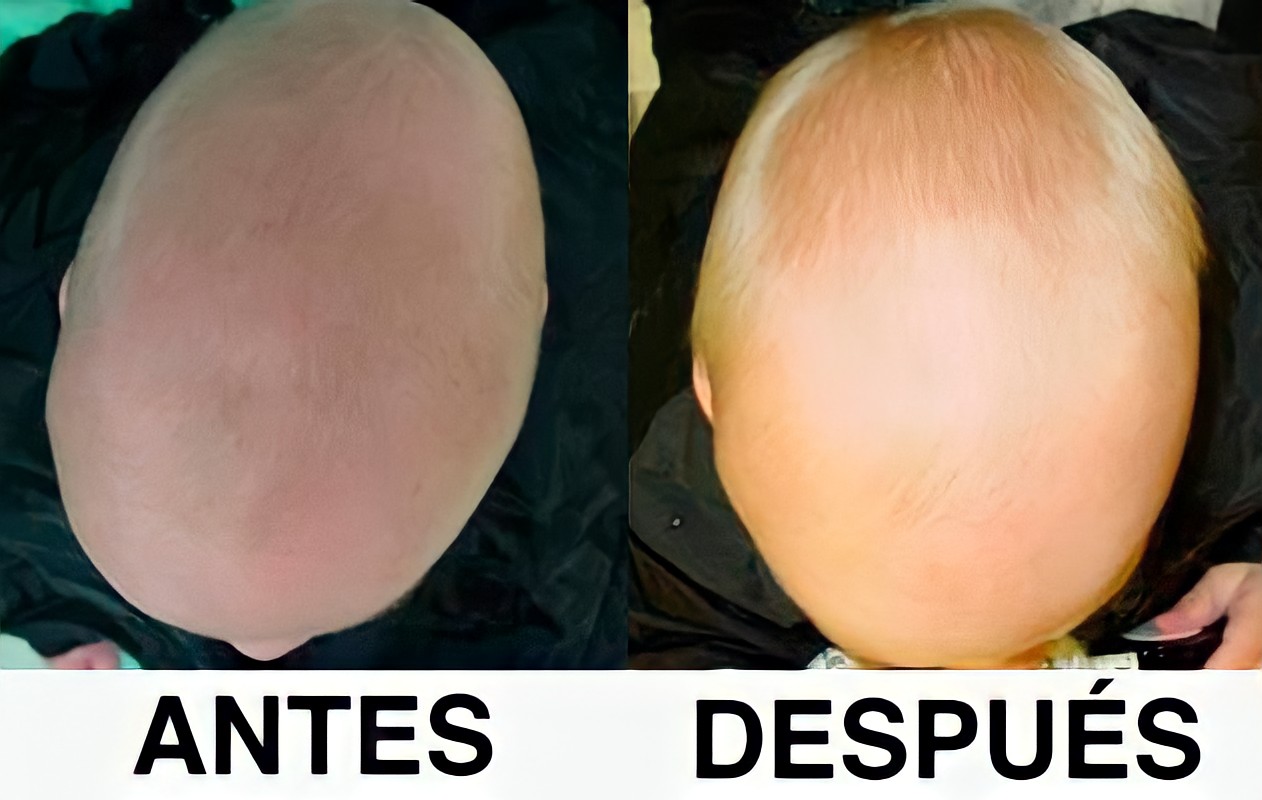 Remodelación craneal