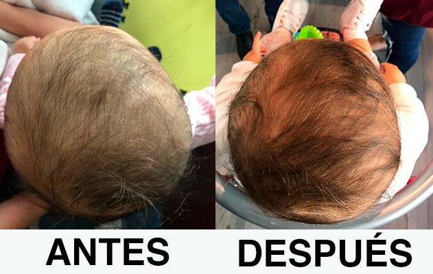 Remodelación craneal